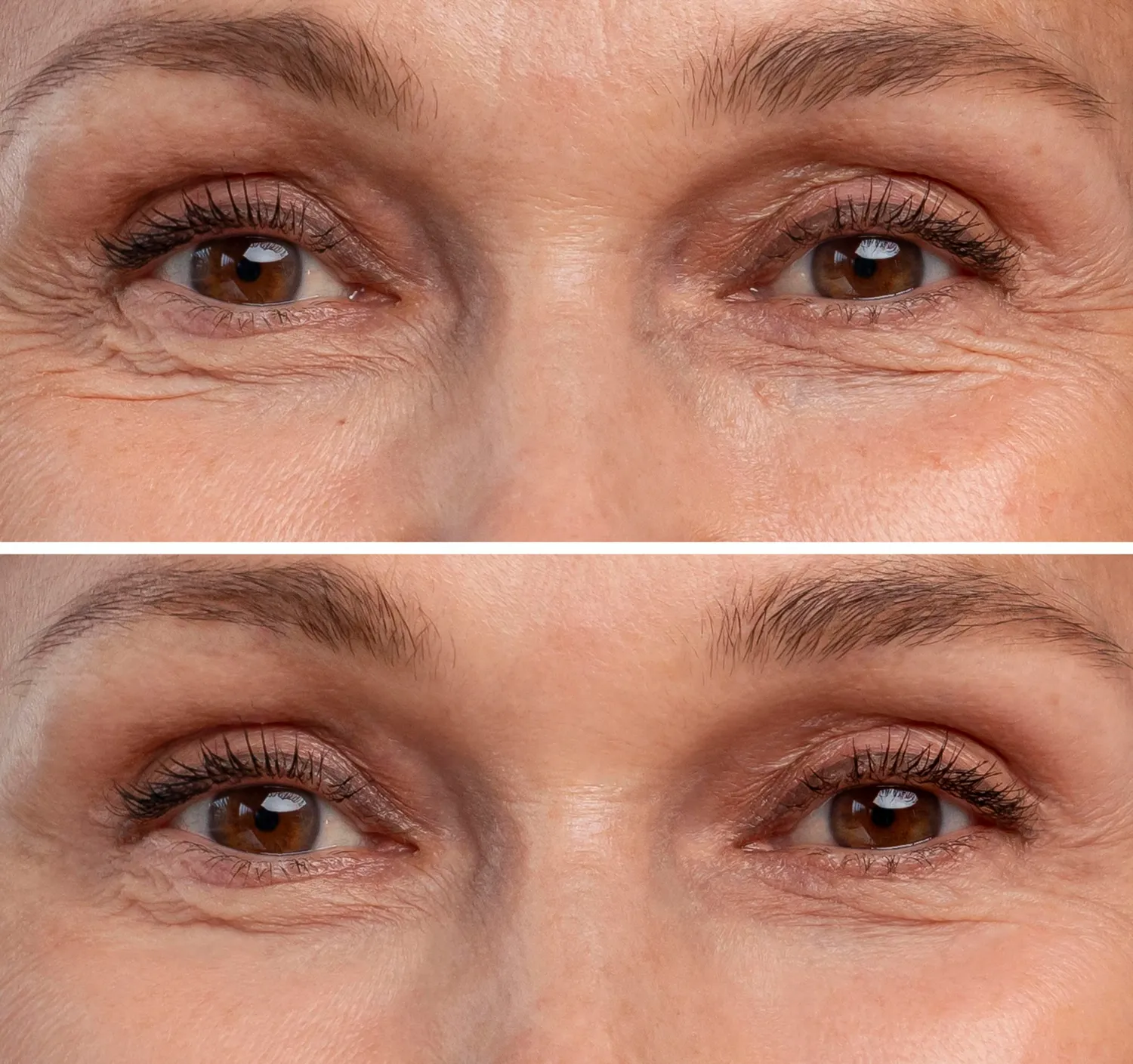 Belotero filler benefits skin enhancement results with smoother texture and a natural look.