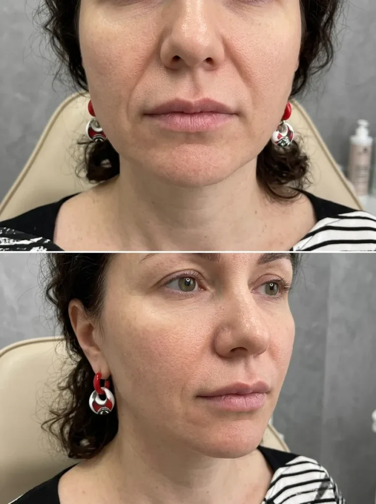 Nasolabial fold direct treatment targeted filler smoothing deep lines around the mouth.