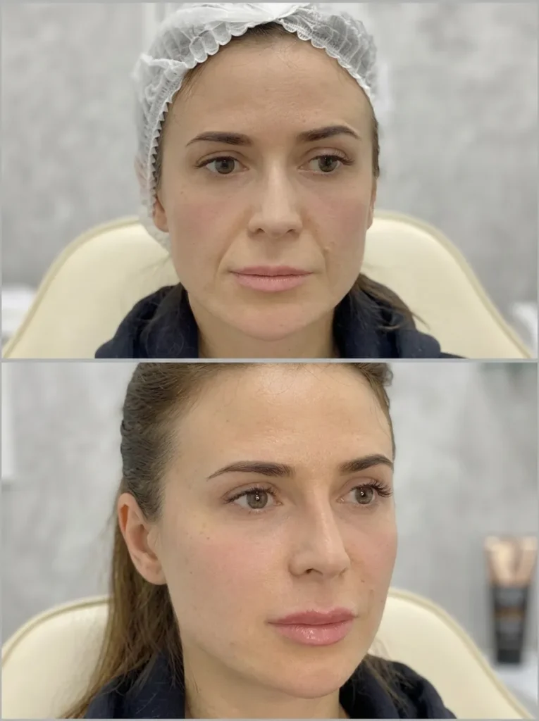 Nasolabial fold filler before and after results showing smoother smile lines and a refreshed look.
