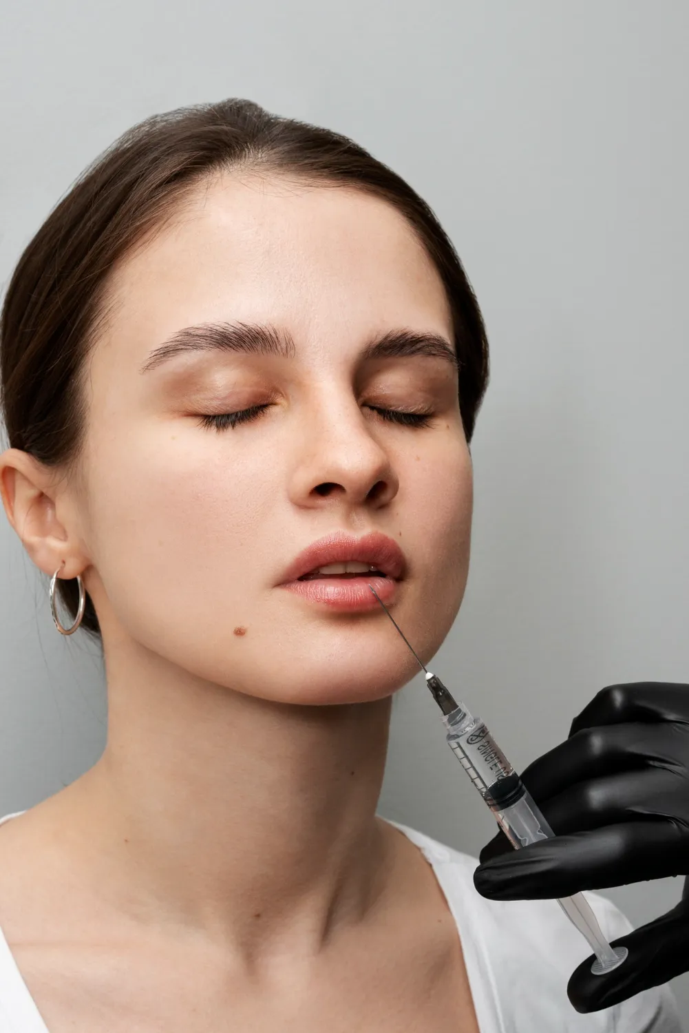 Subtle lip filler benefits natural look with soft volume and smooth lip texture.