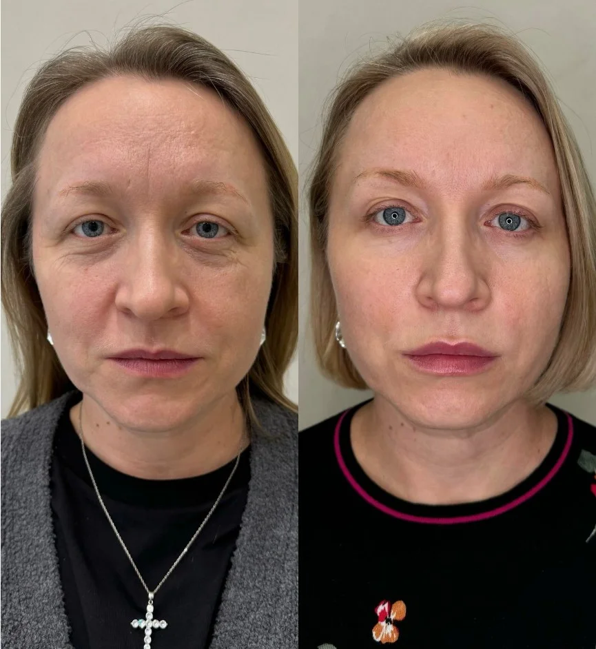 Neuramis Filler Treatments in London