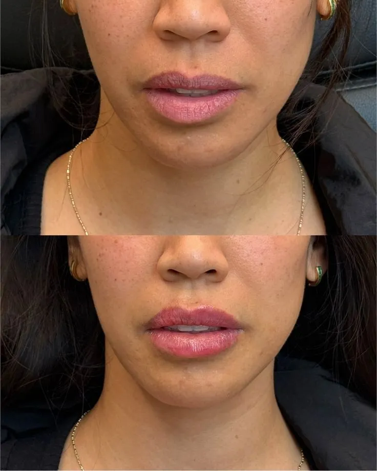 Asymmetrical Lips Filler Treatment in London
