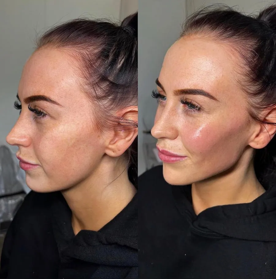 Before and After Kairax Filler Treatment