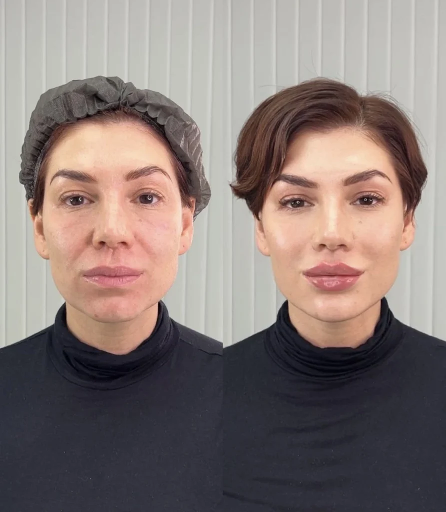 Bellafill Filler Treatment in London