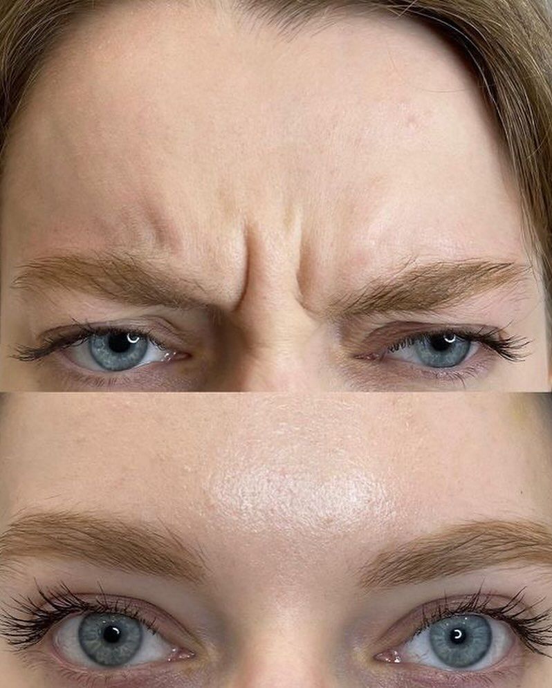 Botox Treatments in London