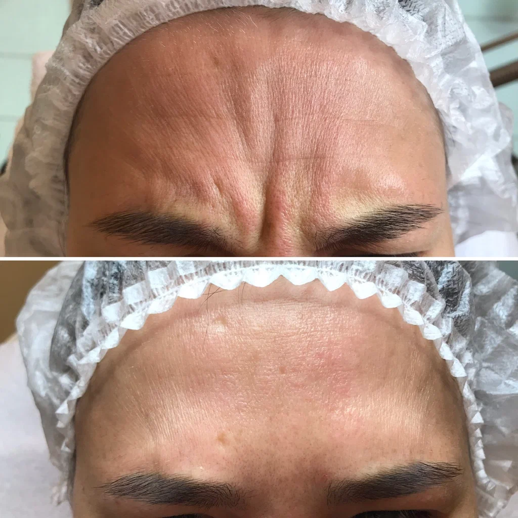 Glabellar Lines Botox Treatments in London