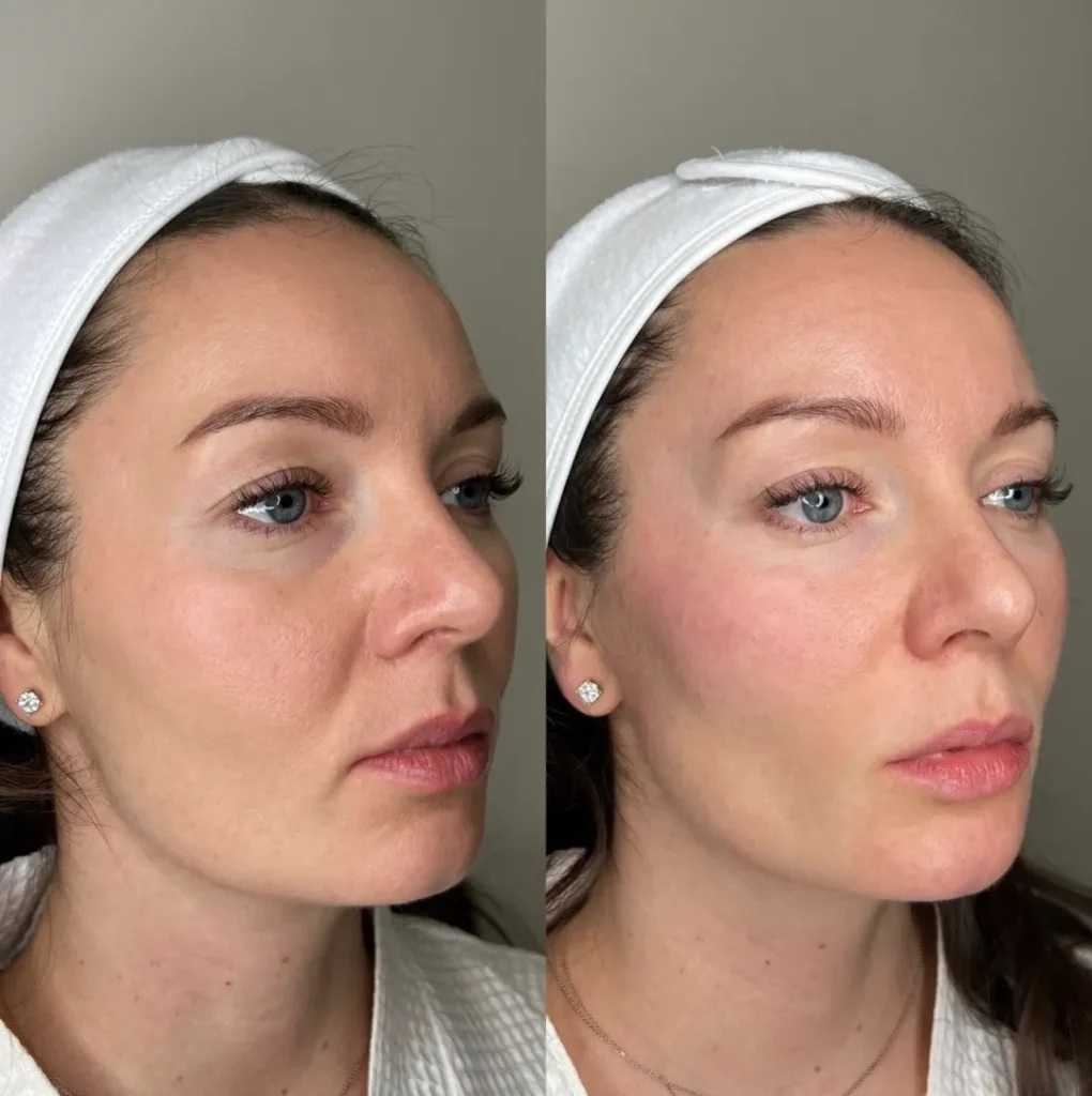 Kairax Filler Treatments in London