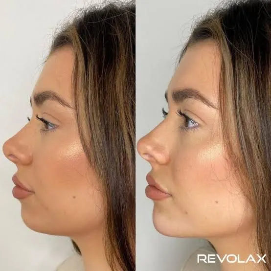 Revolax Filler Treatments in London